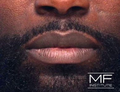 Close up of a man's lips, before Lip Filler treatment for smoothness and definition.