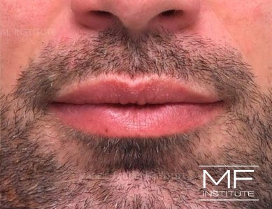 Close up of a man's lips, after the Subtle Lip Filler treatment.