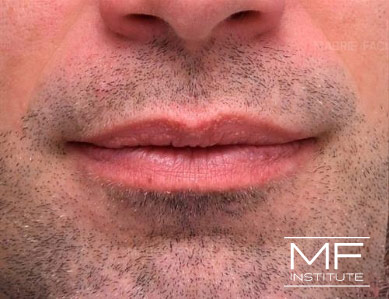 Close up of a man's lips, before the Subtle Lip Filler treatment.