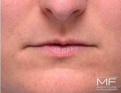 Close up of a woman's lips, before receiving Lip Filler treatments.