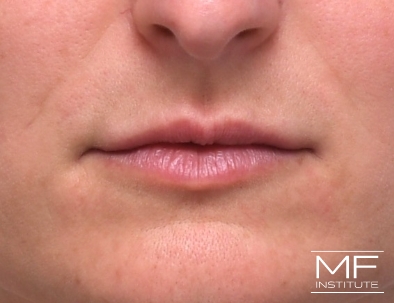 Close up of a woman's lips, after receiving the first of two Lip Filler treatments.