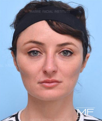 Woman after masseter botox treatment.