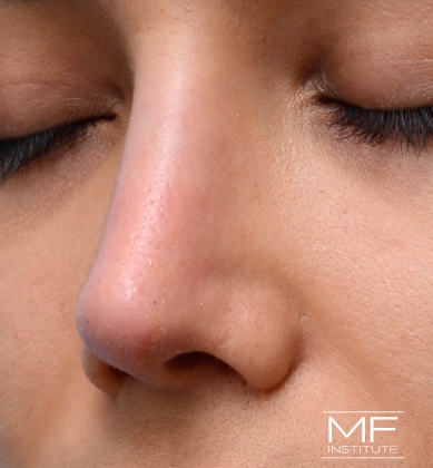 Woman after non-surgical rhinoplasty correction to straighten an upturned tip.