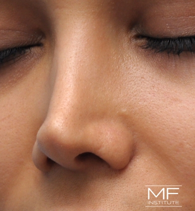 Woman before non-surgical rhinoplasty correction to straighten an upturned tip.