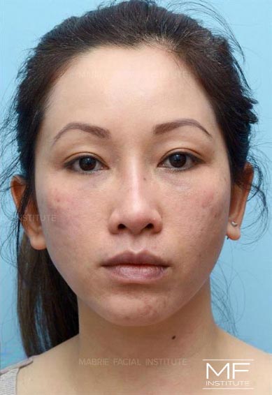 Woman after nasolabial treatment