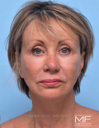 Woman after nasolabial treatment