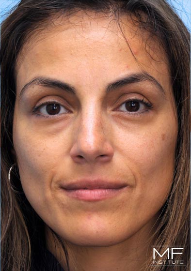 Woman after one of two nasolabial treatments