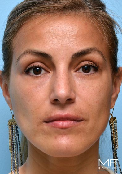 Woman after two of two nasolabial treatments