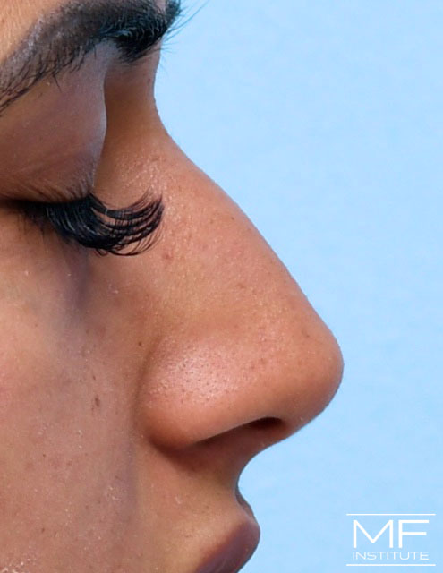 Profile close up of a woman's nose, after the first of two non surgical rhinoplasty treatments.