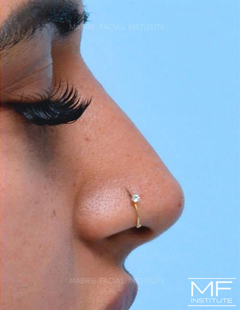 Profile close up of a woman's nose, after the second of two non surgical rhinoplasty treatments.