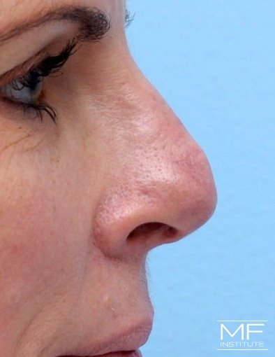 Woman after two nose filler treatments