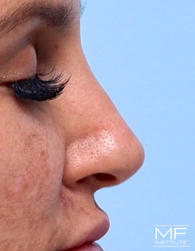 Closeup of a woman's nose after nonsurgical nose job with fillers treatment.