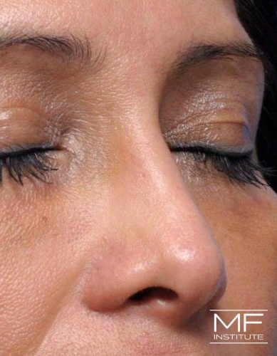 Closeup of a woman's nose after nonsurgical nose job with fillers treatment.