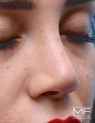 Closeup of a woman's nose after nonsurgical nose job with fillers treatment.