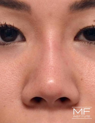 Closeup of a woman's nose after nonsurgical nose job with fillers treatment.