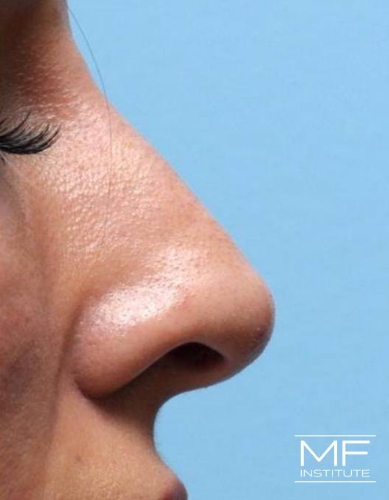 Closeup of a woman's nose after nonsurgical nose job with fillers treatment.