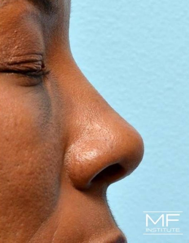 Closeup of a nose after nonsurgical nose job with fillers treatment.