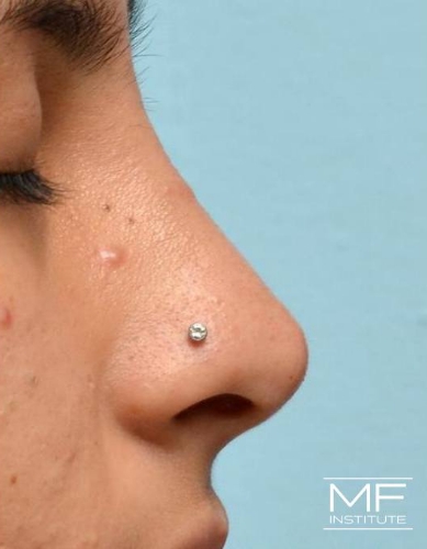 Closeup of a woman's nose after nonsurgical nose job with fillers treatment.