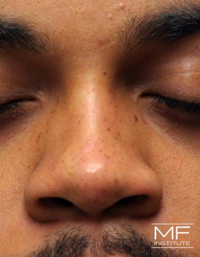 Closeup of a man's nose after nonsurgical nose job with fillers treatment.