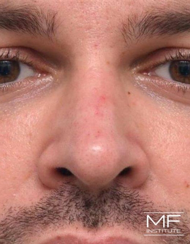 Closeup of a man's nose after nonsurgical nose job with fillers treatment.