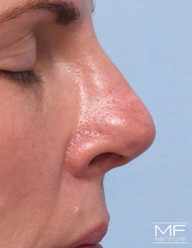 Woman after three nose filler treatments