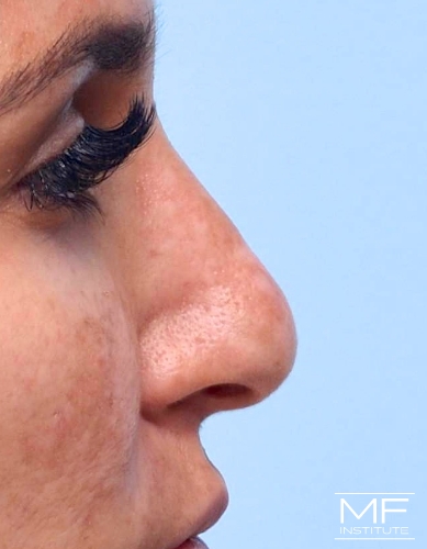 Closeup of a woman's nose before nonsurgical nose job with fillers treatment.