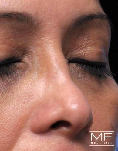 Closeup of a woman's nose before nonsurgical nose job with fillers treatment.