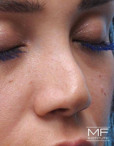 Closeup of a woman's nose before nonsurgical nose job with fillers treatment.