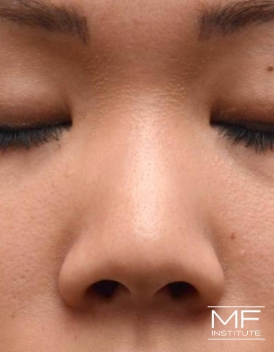 Closeup of a woman's nose before nonsurgical nose job with fillers treatment.