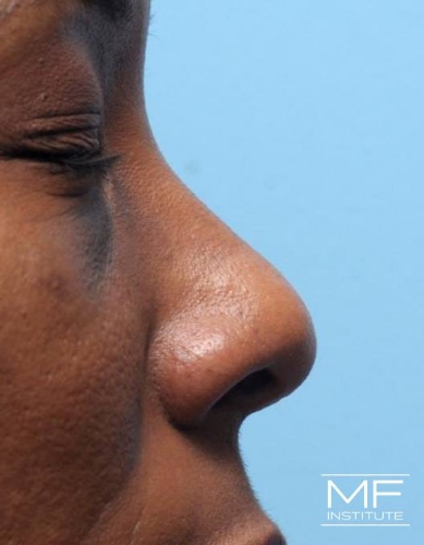 Closeup of a nose before nonsurgical nose job with fillers treatment.