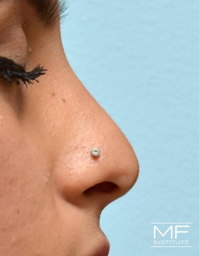 Closeup of a woman's nose before nonsurgical nose job with fillers treatment.