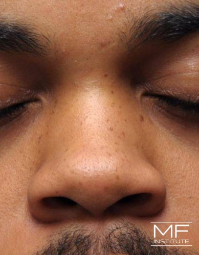 Closeup of a man's nose before nonsurgical nose job with fillers treatment.