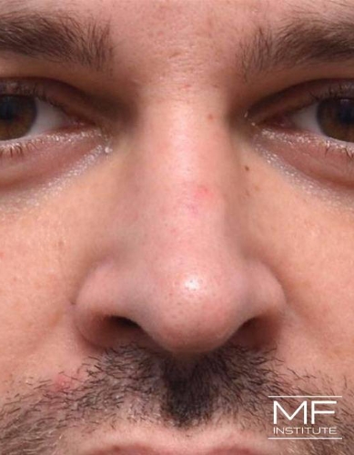 Closeup of a man's nose before nonsurgical nose job with fillers treatment.