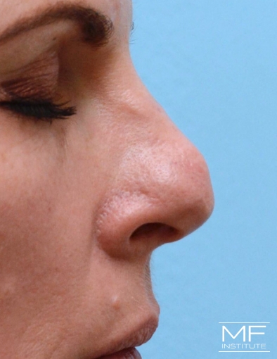 Woman before nose filler treatment