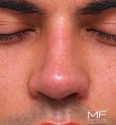 Man after non-surgical rhinoplasty correction to address nostril irregularities