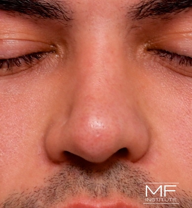 Man before non-surgical rhinoplasty correction to address nostril irregularities