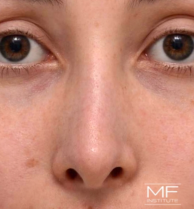 Woman after non-surgical rhinoplasty correction to straighten the bridge of her nose