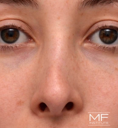 Woman before non-surgical rhinoplasty correction to straighten the bridge of her nose