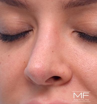 Woman after non-surgical rhinoplasty correction to widen a narrow bridge.