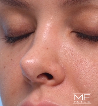 Woman before non-surgical rhinoplasty correction to widen a narrow bridge.