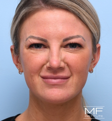 Woman's face after targeted bunny lines treatment.