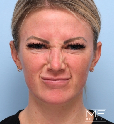 Woman's face before targeted bunny lines treatment.