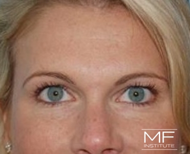 Woman after under eye BOTOX treatment.