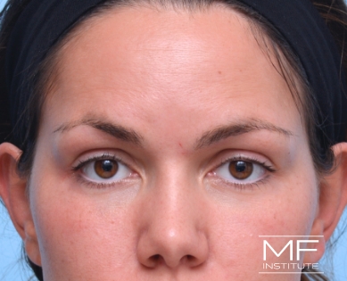 Woman after under eye BOTOX treatment.