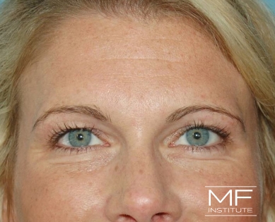 Woman before under eye BOTOX treatment.