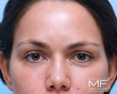 Woman before under eye BOTOX treatment.