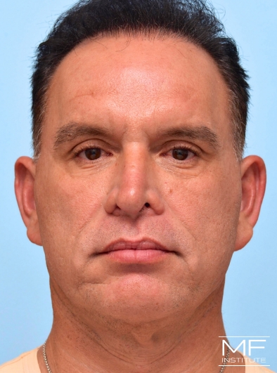 Man after one Under Eye Wrinkles treatment with Filler.