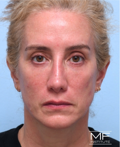 Woman after Filler for Under Eye Wrinkles treatment.