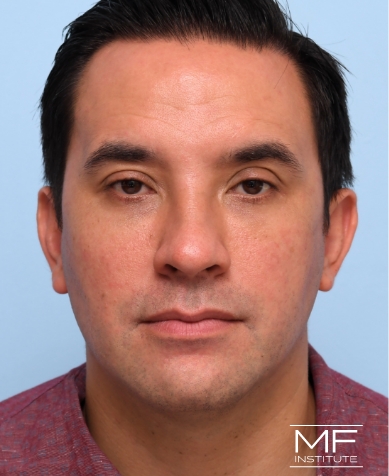 Man after Filler for Under Eye Wrinkles treatment.