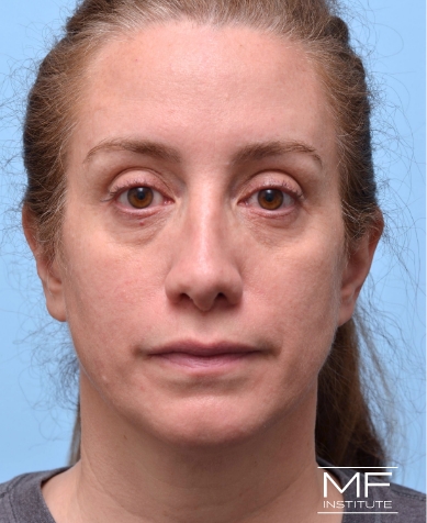 Woman before Filler for Under Eye Wrinkles treatment.